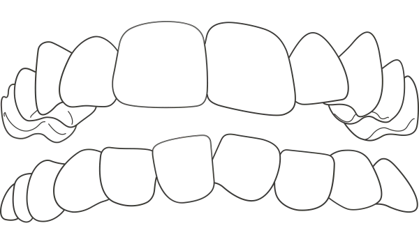 Ilustração: Dentes apinhados