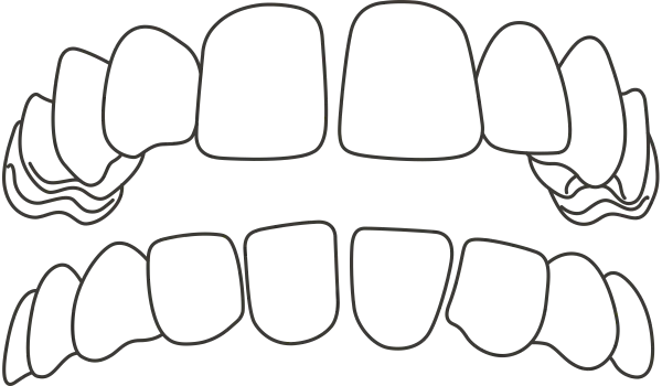 Ilustração: Diastema e espaços