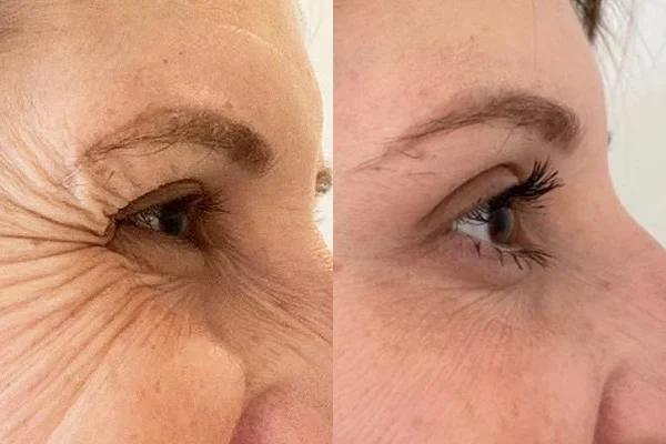 Antes e depois da região dos olhos: rugas dos pés de galinha suavizadas