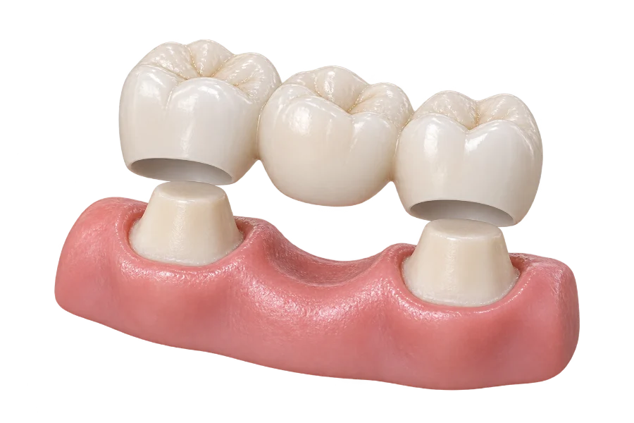 Ponte fixa de três dentes apoiada nos dentes das extremidades