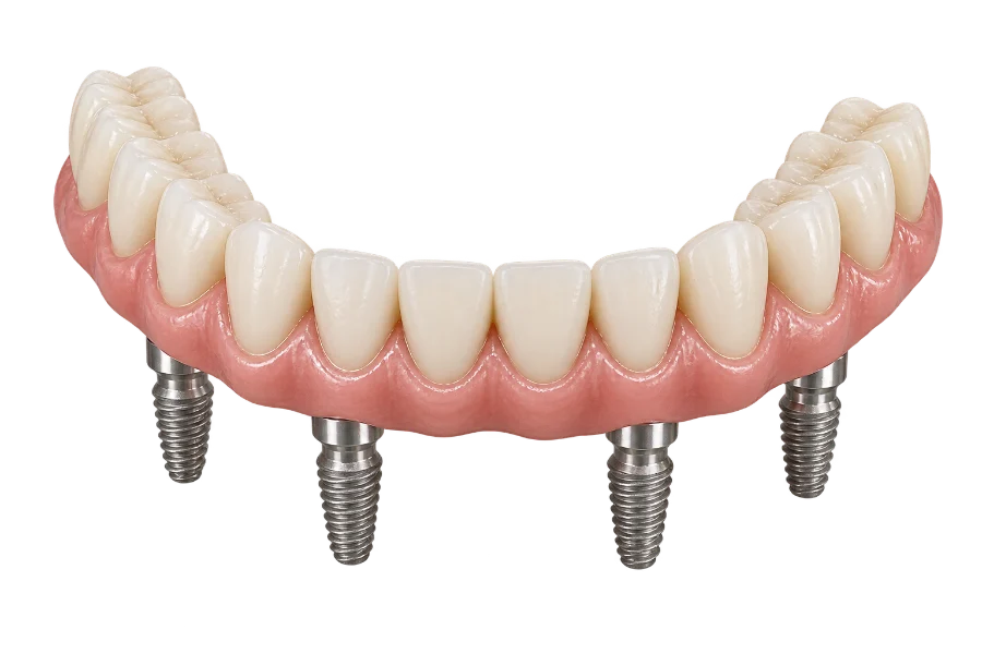 Prótese fixa de arcada completa sustentada por quatro implantes